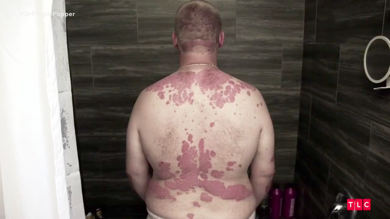 Illustration for article titled Dr. Pimple Popper Removes 68 Lipomas from One Person in Season 2 Premiere
